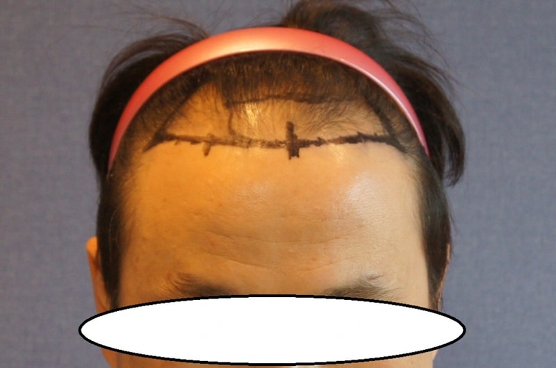Motion 2800 Hair follicle hairline + 11 months of upper limb hair transplantation