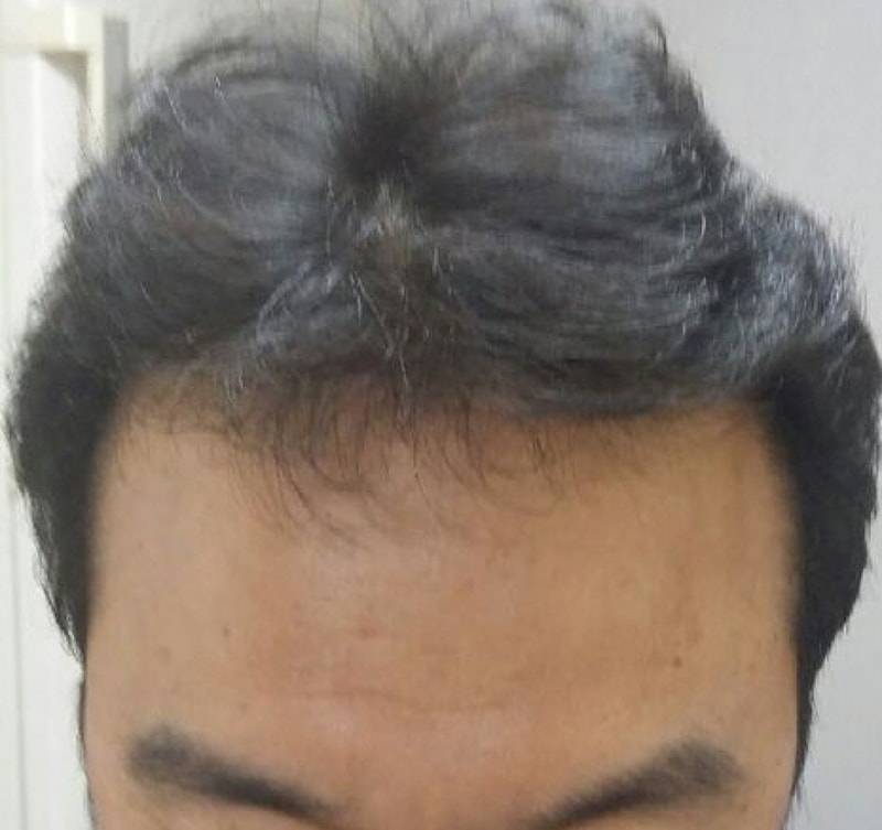 모션 1400모낭 비절개 모발이식 수술 8개월 경과입니다