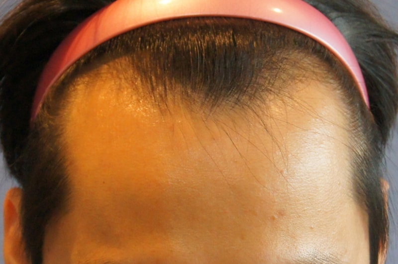 Motion 1400 follicle transplantation 6 months later Photo