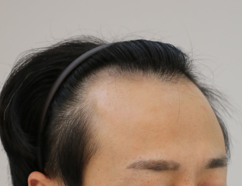 非切開 ボックスカット 1200毛包