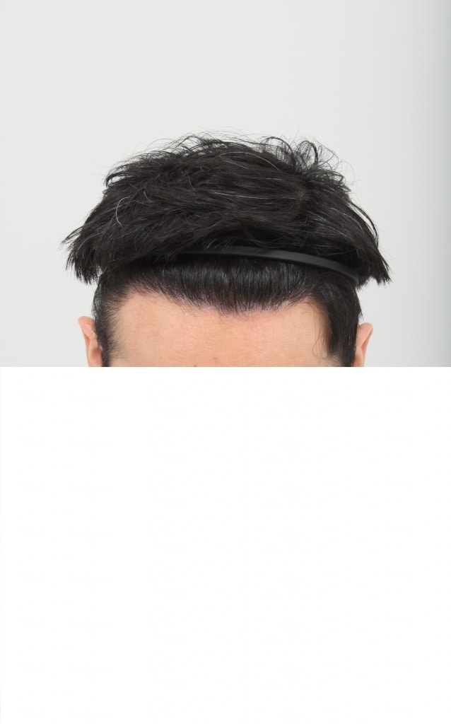 1760 hair follicle ㅍ hhh review