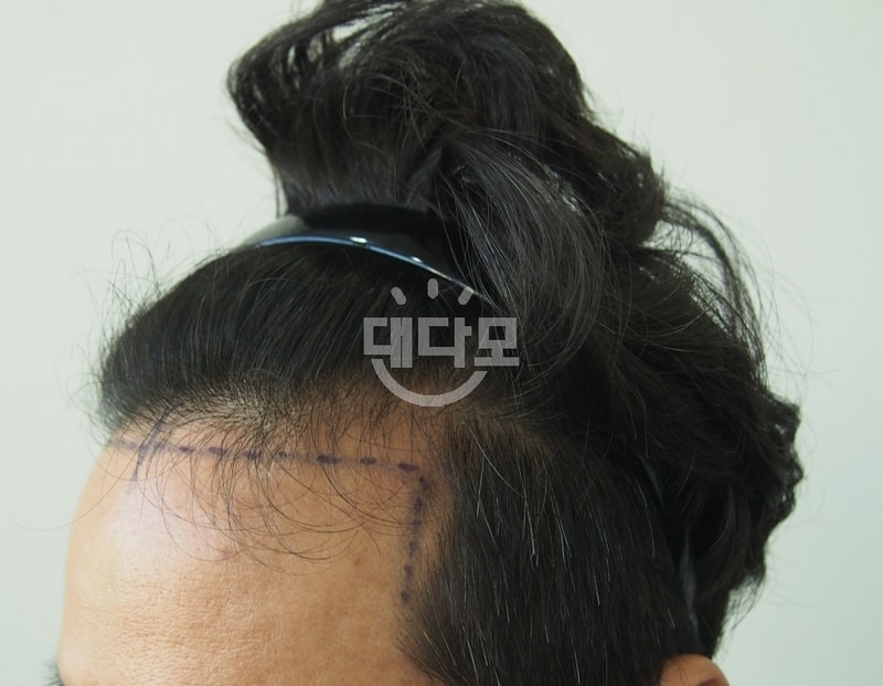 수술직전 3.jpg
