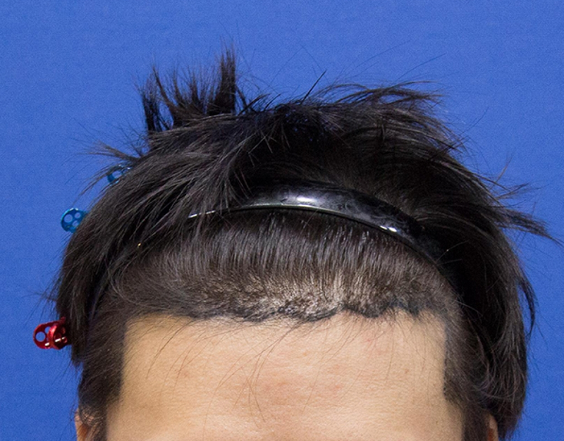 이식7일_정면.png