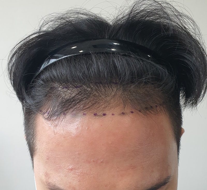 额头线头发移植一个半月后记（非切开、削发）