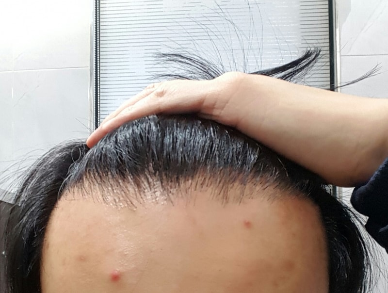 재수술 직전.jpg
