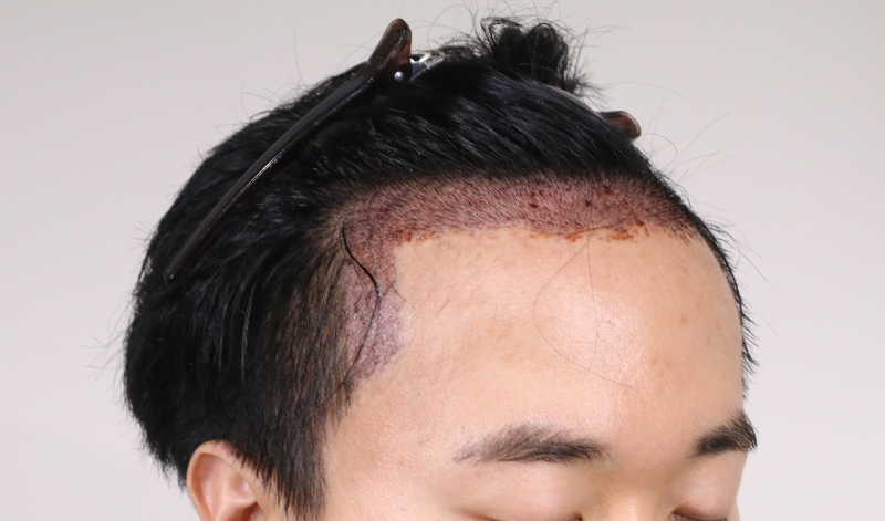모발이식 후 사진1.PNG