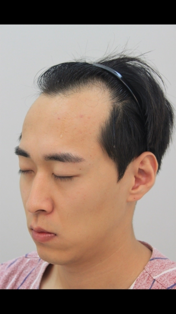 It's been a year and eight months since the forehair surgery