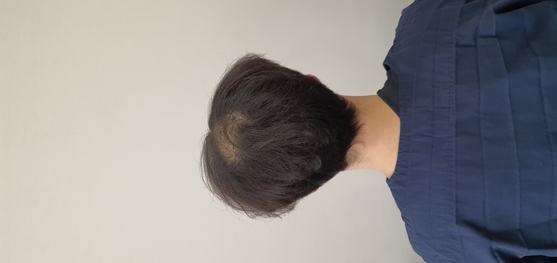 虽然为时已晚，但手术后会立即留下后记。