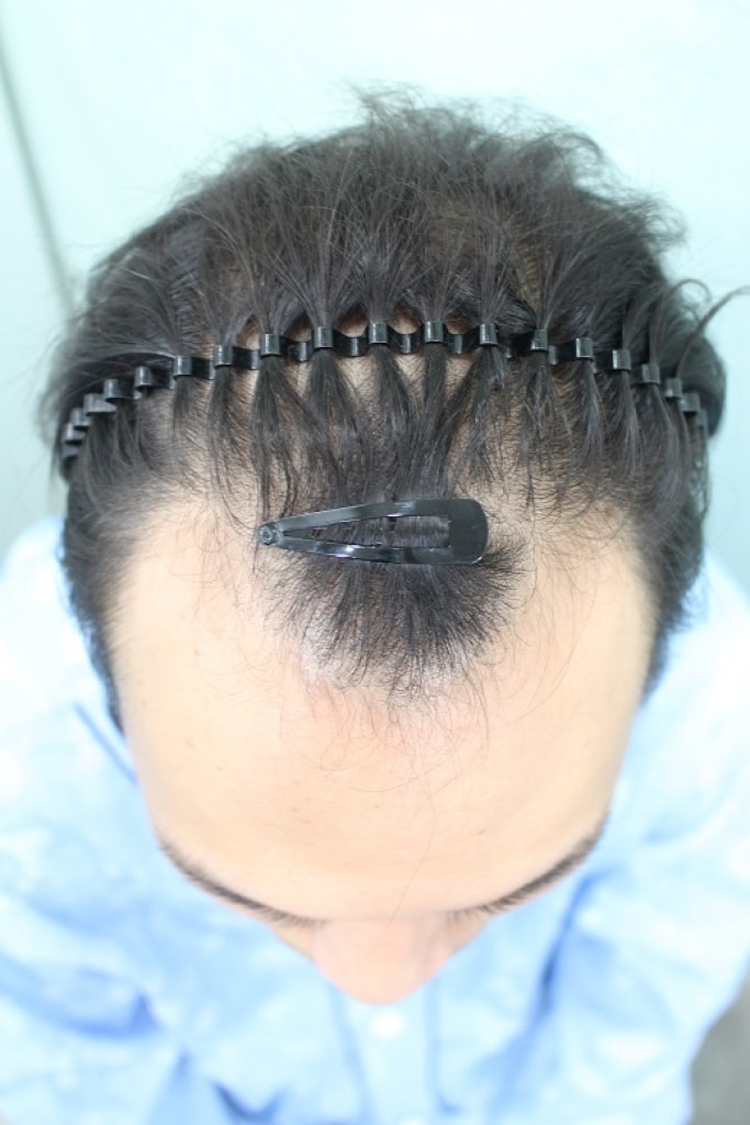 切開 3360本 M字移植
