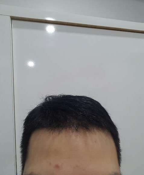 M型毛发移植手术目前已经进行了4个月。