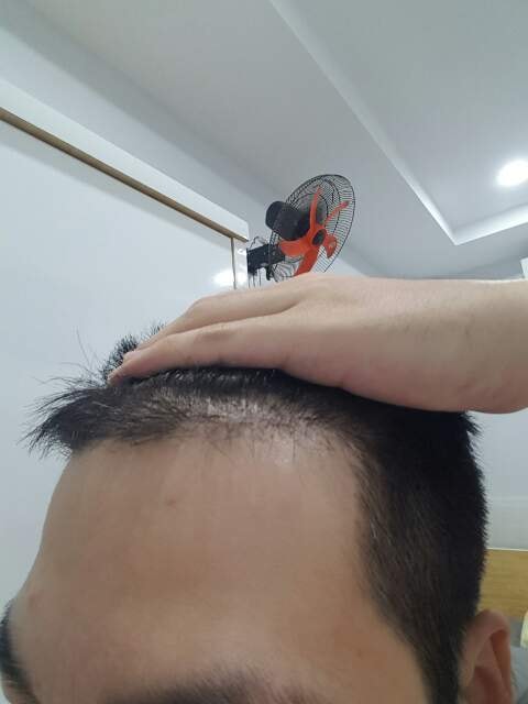 왼쪽머리 4개월차.jpg