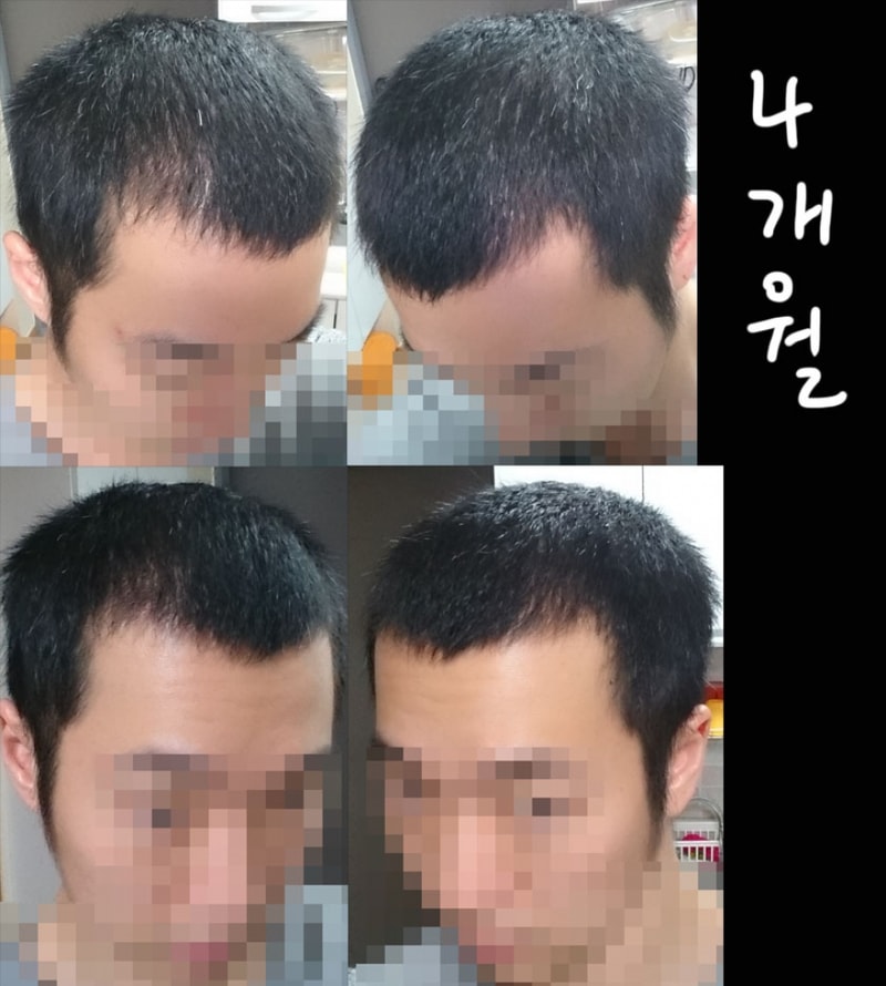 뉴헤어 비절개 1600모낭 3개월차