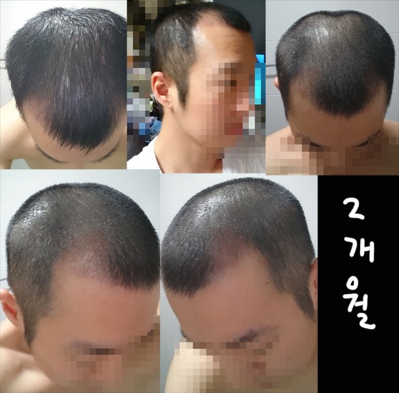 뉴헤어 비절개 1600모낭 2개월차
