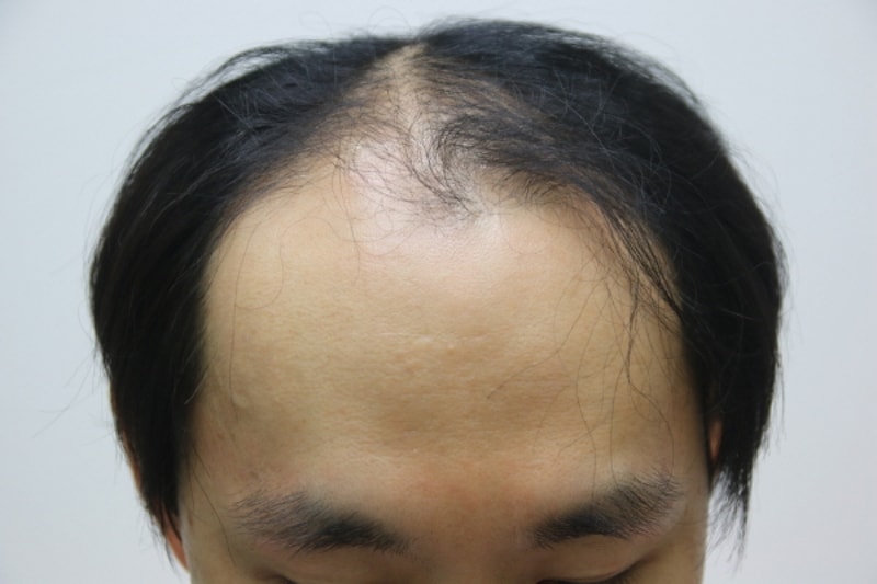 Forehead 2000 Hair follicle transplant 6 months and hair style change!