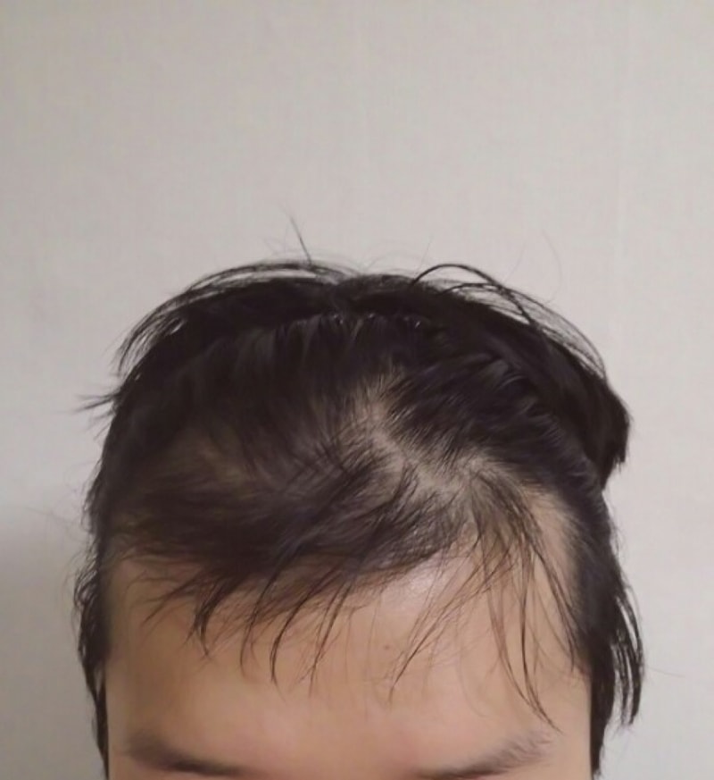 1200毛囊 9个月