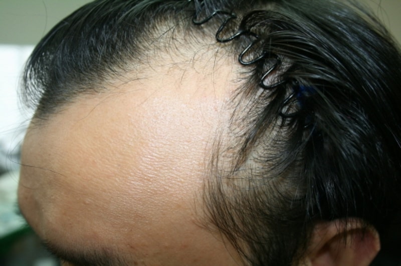 ポヘア移植180日が過ぎました。
