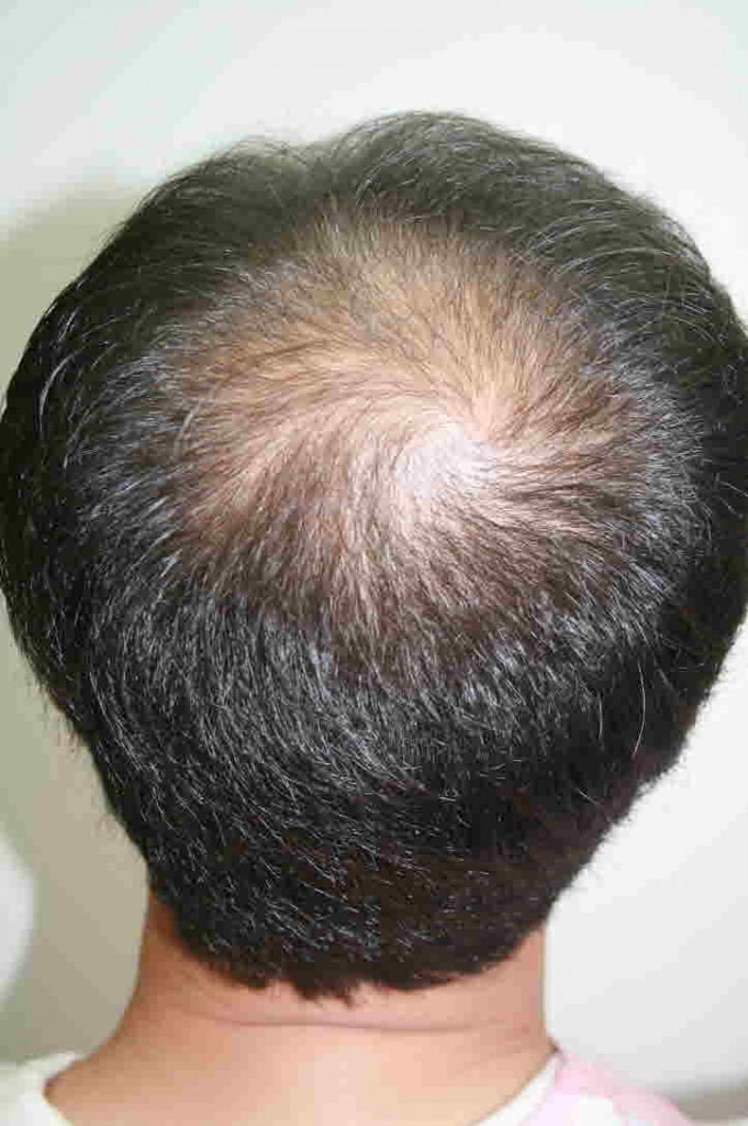 ポヘア毛髪移植センターで1000毛包移植手術を受けました。