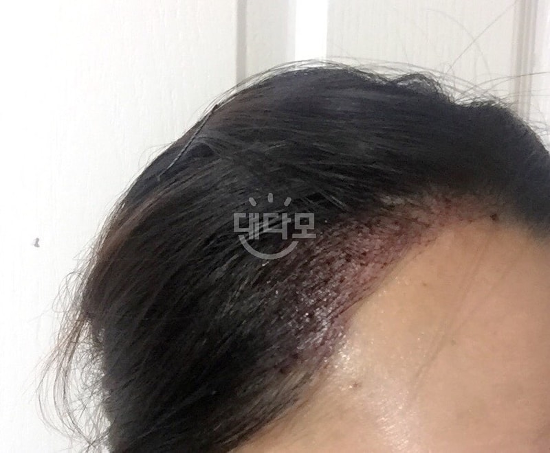 Post your review for three months after the surgery
