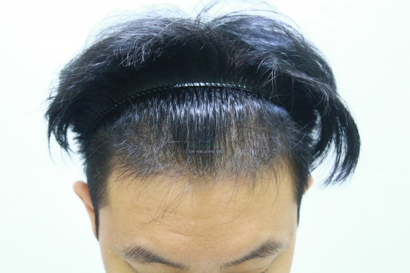 1700 hair follicle Daegu Pohair Evaluation 2