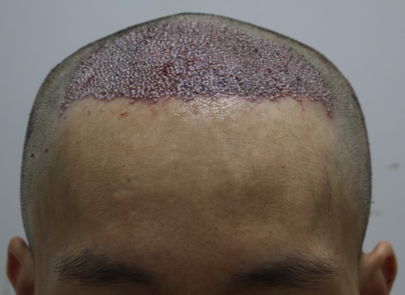 수술후.JPG