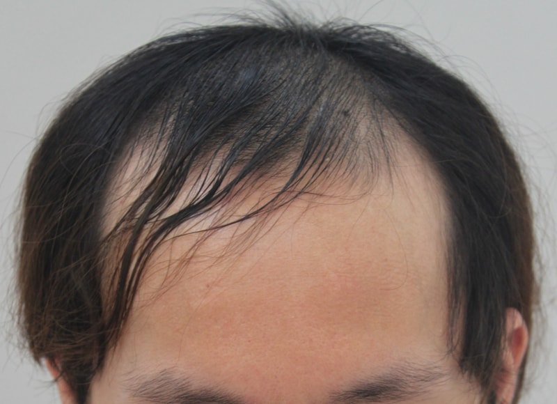 FORHAIR毛发移植人生第一次后记