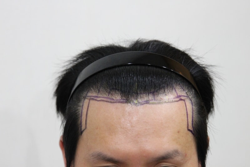 ニューヘアで2次手術をしてから8ヶ月になりますね