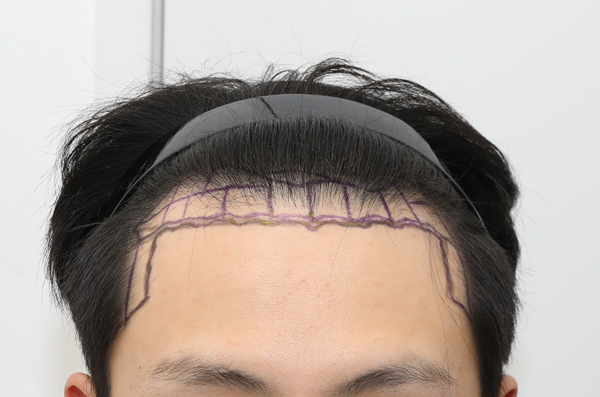 New Hair Seoul Branch Non-cut 1700 Hair follicle (3400 Mo) Day 2 Review!!