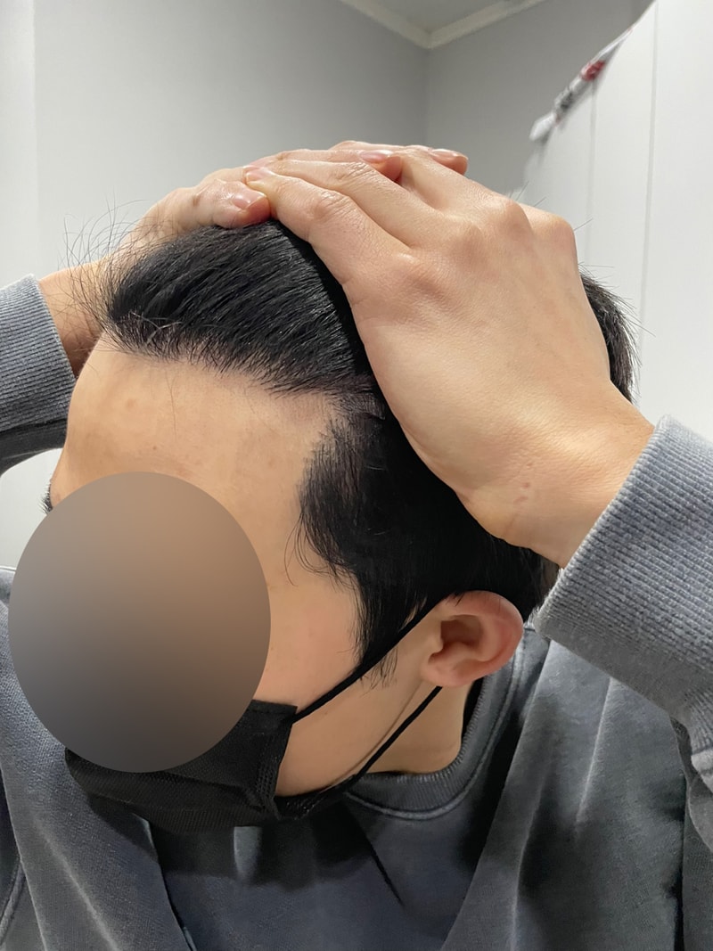 비절개 1500모낭 8개월 수술후기