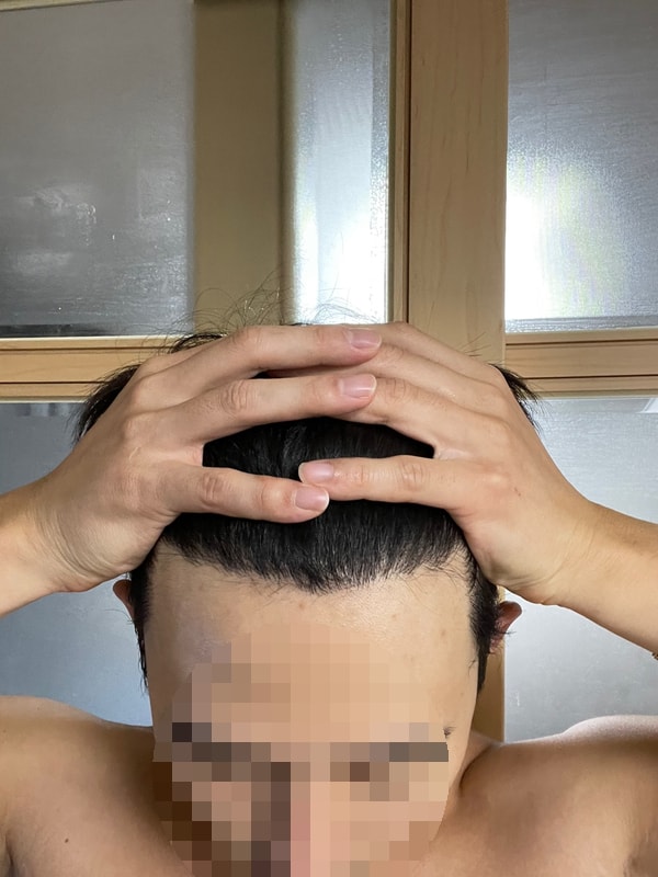 비절개 모발이식 6개월..1/2 지난 시점 사진 공유합니다.
