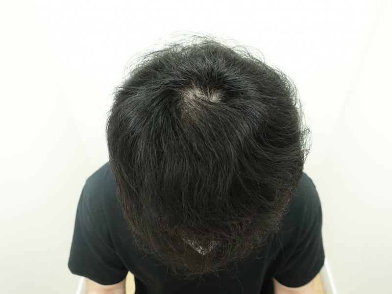 5.수술6개월차.jpg