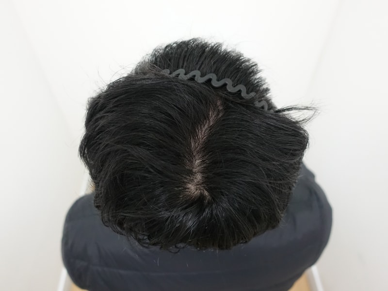 4.수술3개월차2.jpg