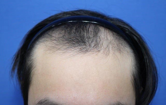 I've been having 4,000 hair loss transplants for type A