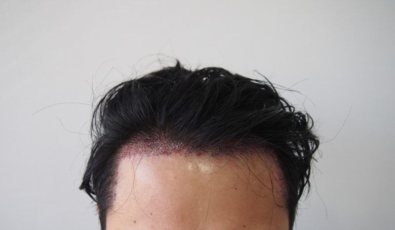 수술후 정면.jpg