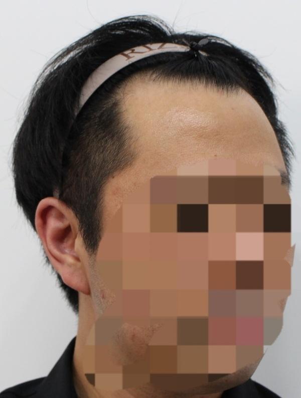 釜山Lizmo医院非切开毛发移植第1年