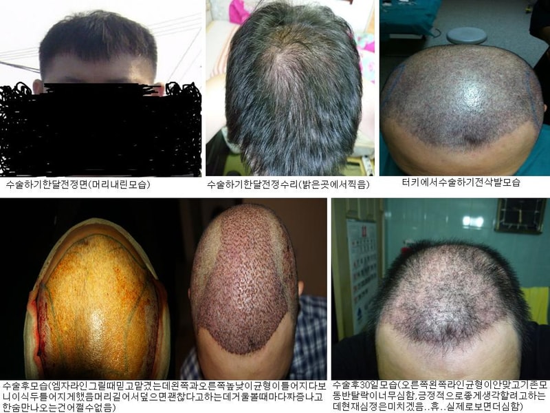 터기수술.JPG