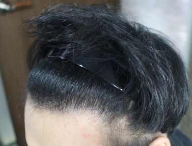 8개월 경과후 측면.PNG