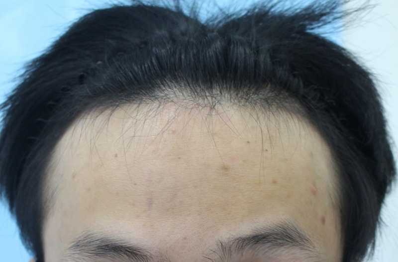 한나이브모발이식센터 절개식 3000모 후기 후기
