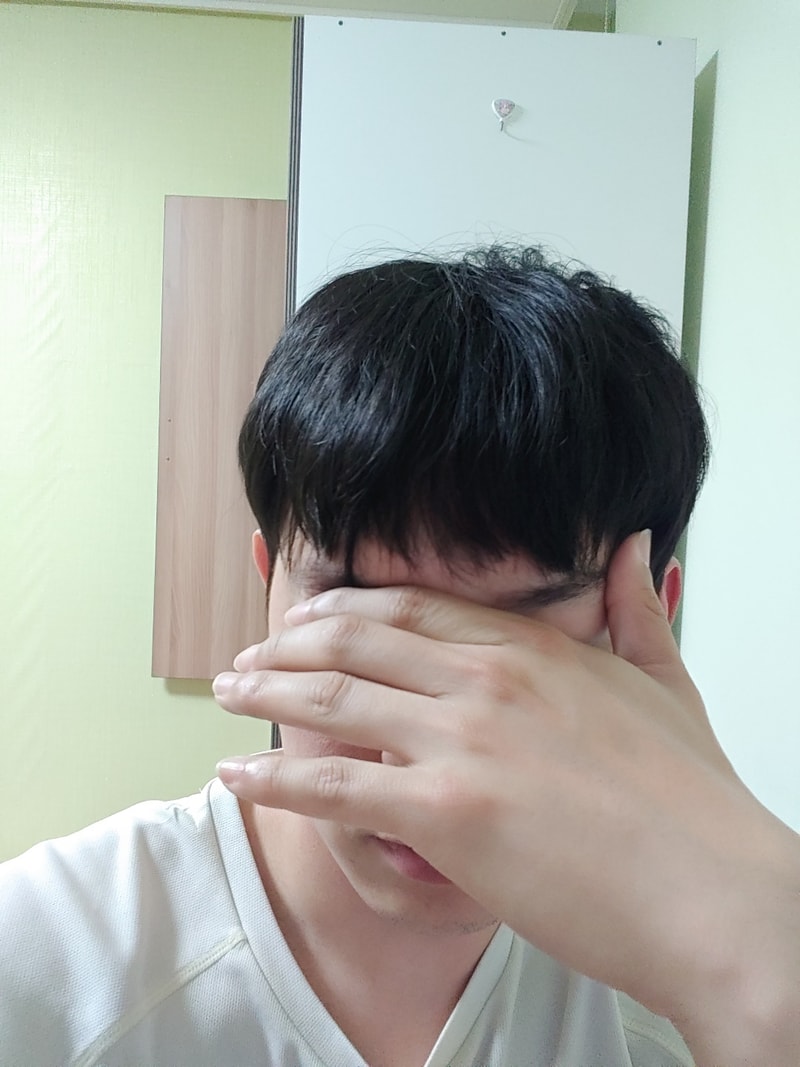 M자형 탈모 비절개 4044모 이식 성공 2년차 후기 입니다!