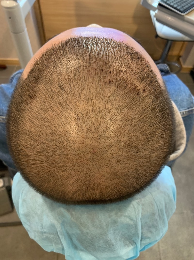 I leave a review of non-cutaneous hair transplantation + injection treatment.