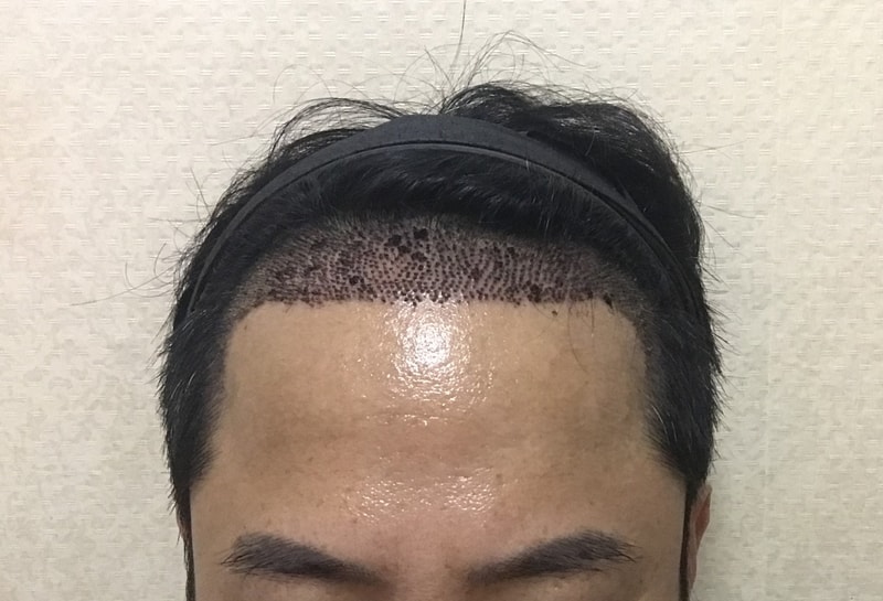 이식후 1주일 정면.jpg