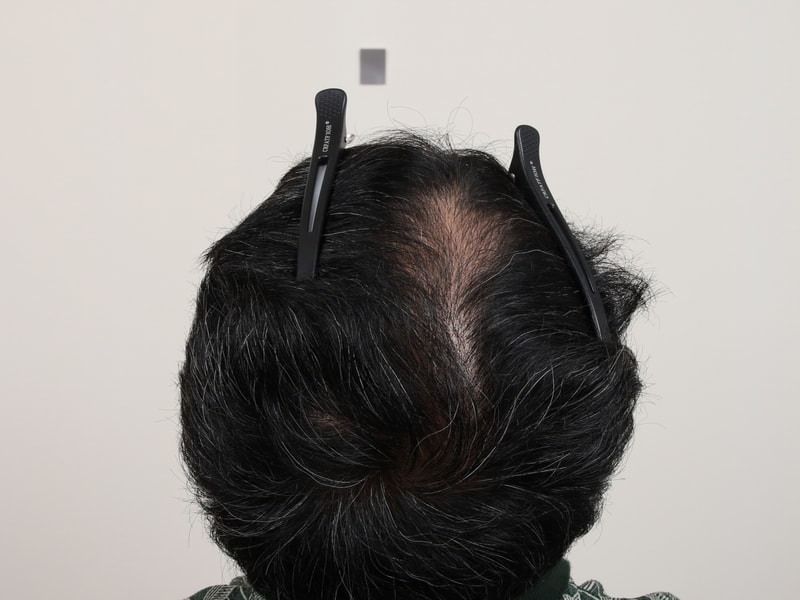 수술 경과 4개월2.jpg