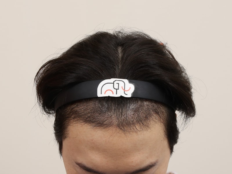 부산모발이식 슬릿방식 맘모스 M자 수술 5개월 차 후기