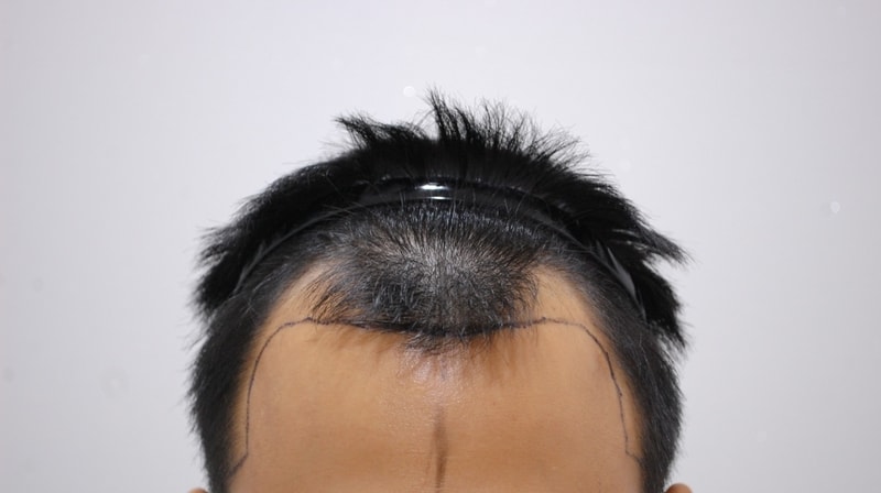 수술전디자인.JPG