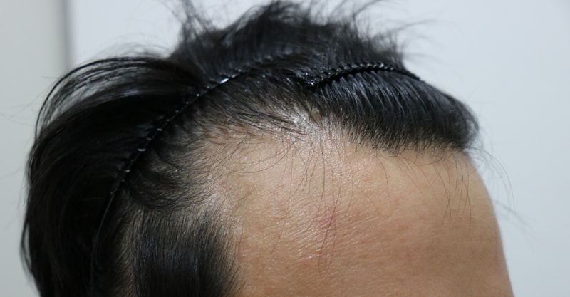 수술전옆.jpg
