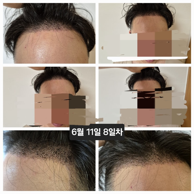 이식8일차.jpg