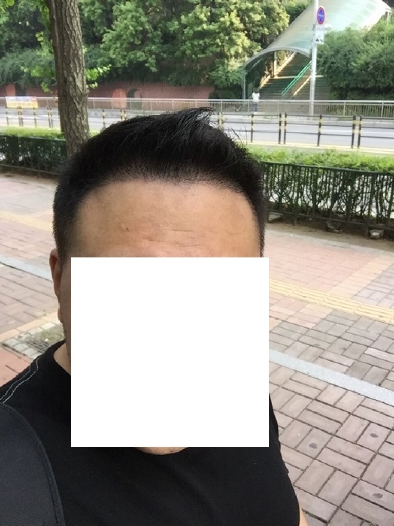 수술후 짧은머리.jpg