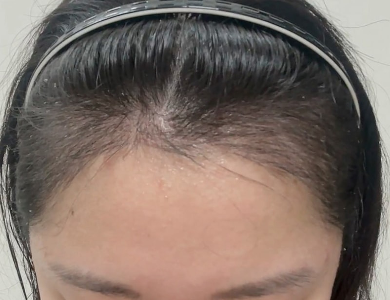 Asymmetrical hairline 3,000 Mo! It's been over a month!