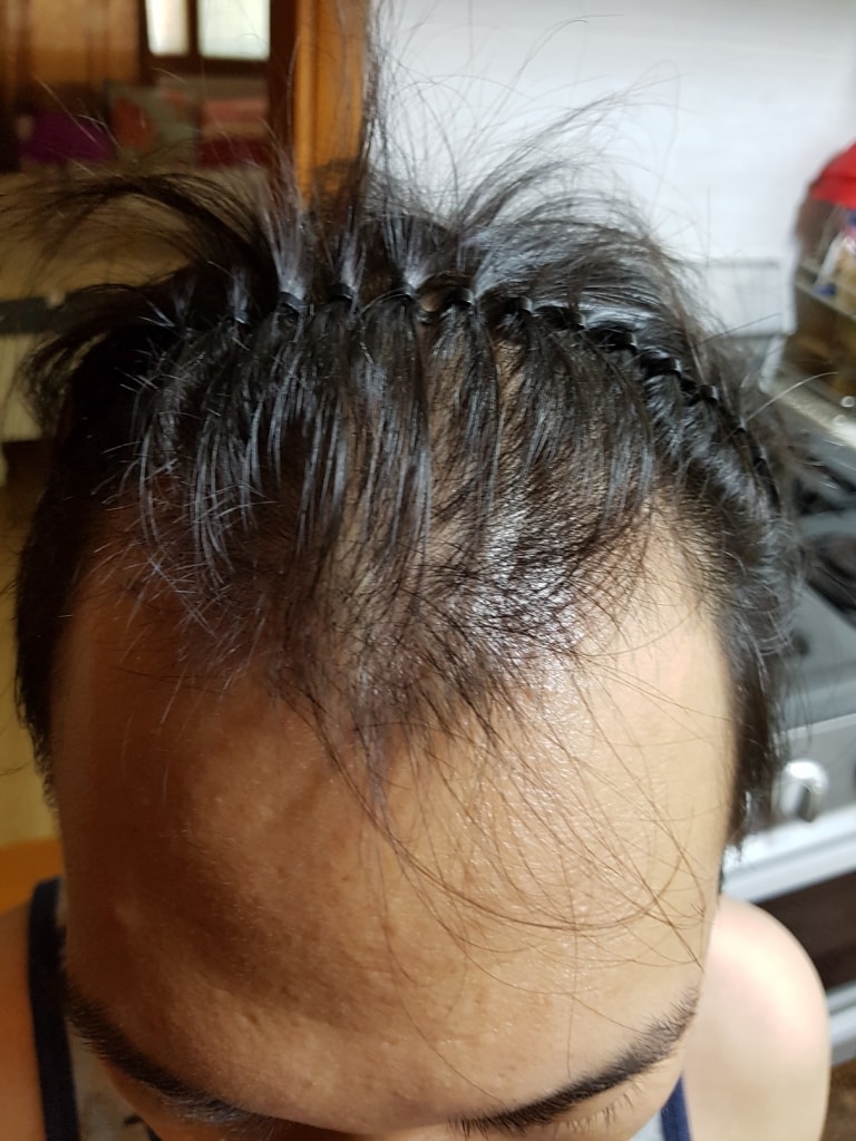 切開 3360本 M字移植