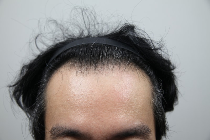 평생 소원이였던 모발이식 1일차 후기입니다!
