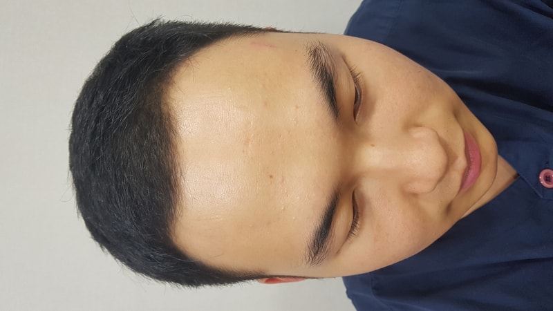 是毛材性手术第1天后期！